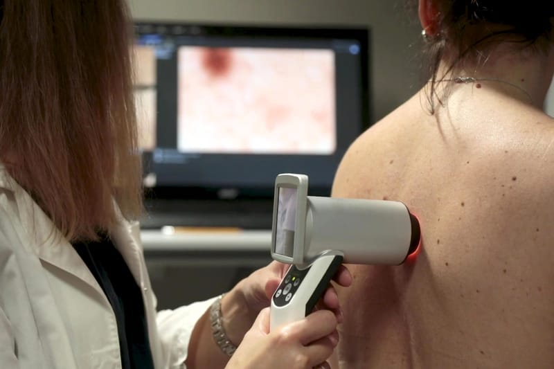 Una dermatologa appoggia il dermatoscopio digitale sulla schiena di una paziente; sullo schermo il neo ingrandito